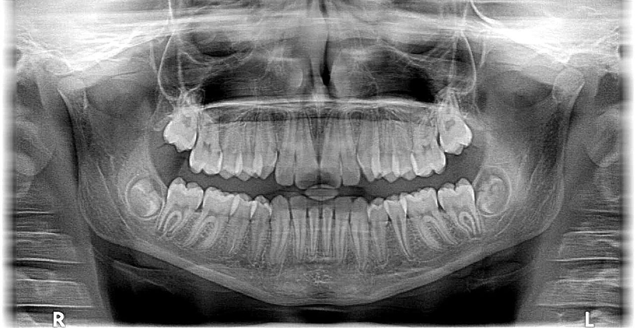 W jakich sytuacjach dentysta może zlecić zrobienie prześwietlenia zęba?